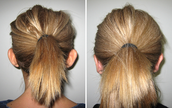 Otoplastica Otoplastica