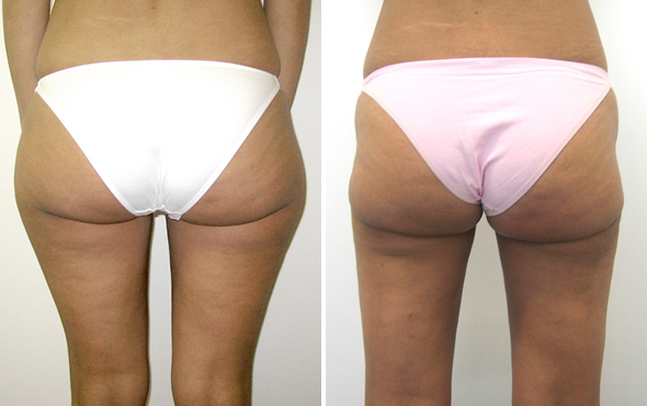 Lipoaspirazione Lipoaspirazione