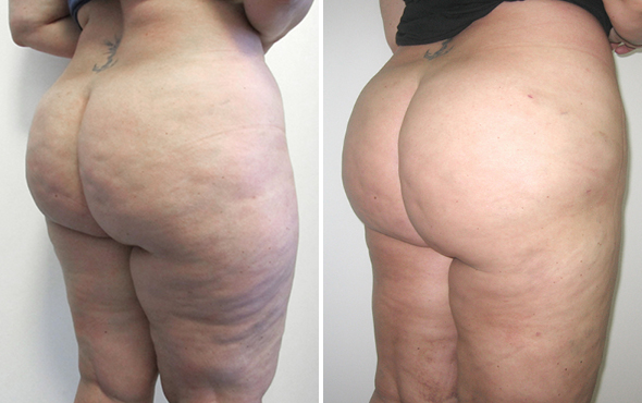 Lipoaspirazione Lipoaspirazione