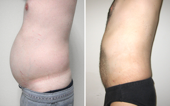 Lipoaspirazione Lipoaspirazione