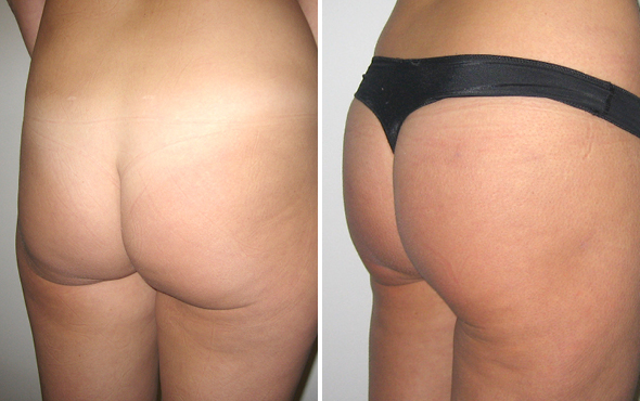 Lipofilling Lipofilling