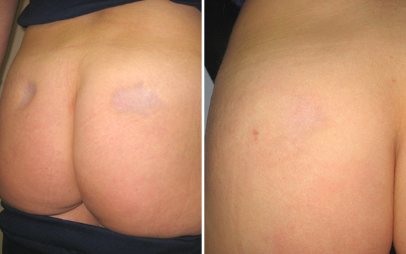 Lipofilling Lipofilling