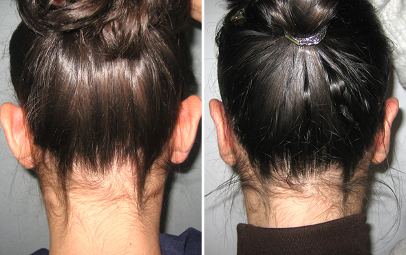 Otoplastica Otoplastica